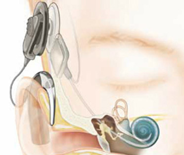cochlear-info